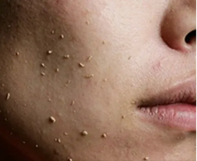 What is Skin Pilling and How to prevent it